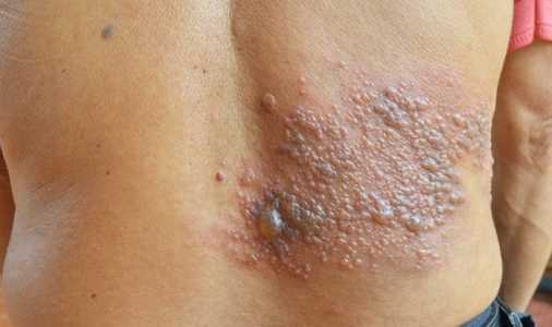 Lesão causada pelo herpes zoster