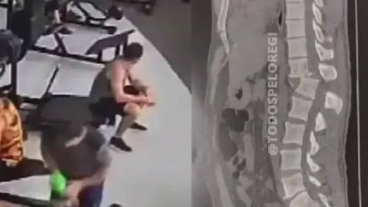 Homem atingido por aparelho em academia tem menos de 1% de chance de voltar a andar