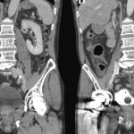 Bactéria da Primeira Guerra Mundial quase mata idoso