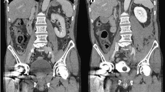 Homem de 64 anos procurou o hospital com febre e dores abdominais