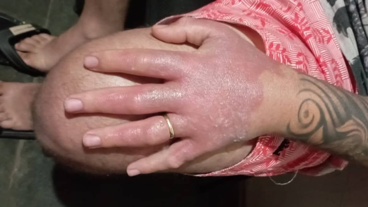 Homem sofre queimadura de segundo grau na mão após manusear limão no sol em MG