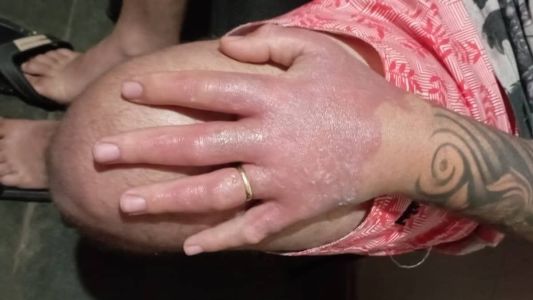 Homem estava manuseando limões para preparar capirinhas quando se queimou com a luz solar