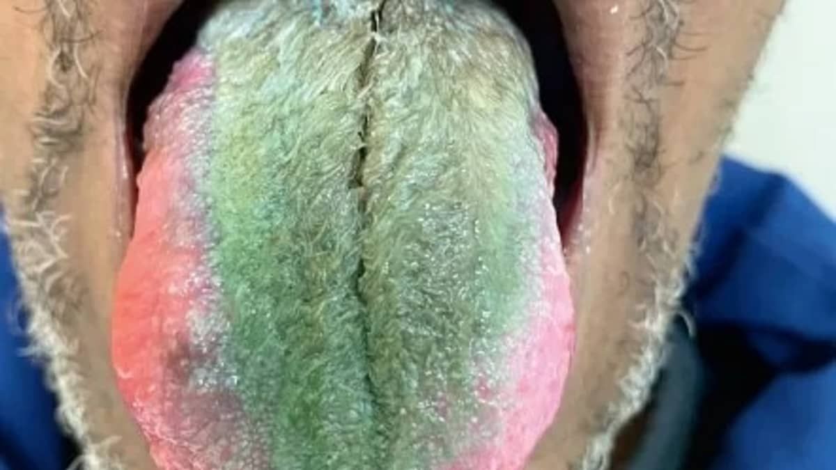 Homem fica com língua verde e peluda após misturar antibiótico com cigarro