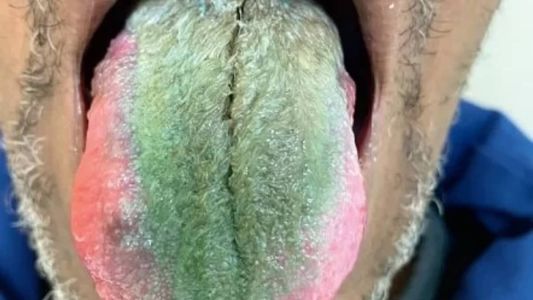 Homem fica com língua verde e peluda