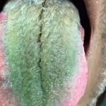 Homem fica com língua verde e peluda após misturar antibiótico com cigarro