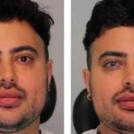 Homem passa por procedimento para trocar cor dos olhos e especialistas criticam