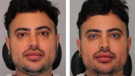 Homem passou pro procedimento que troca cor dos olhos