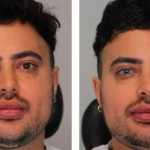 Homem passa por procedimento para trocar cor dos olhos e especialistas criticam