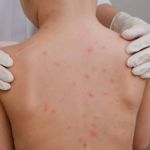 Secretaria de Saúde de Ouro Preto descarta caso de meningite em criança