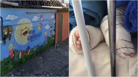 Criança frequentava creche há apenas um mês quando sofreu queimadura de segundo grau