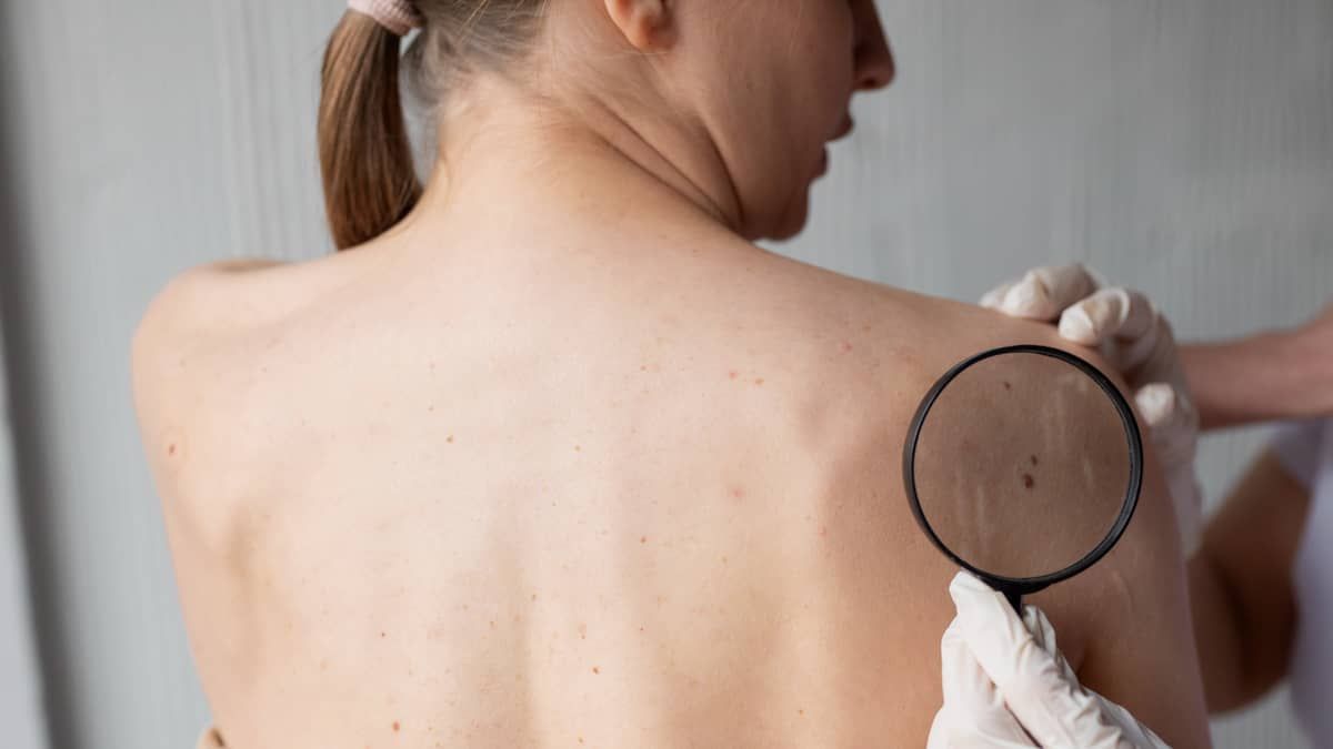 Onda de calor: uso do protetor solar é grande aliado na prevenção contra câncer de pele