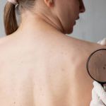 Onda de calor: uso do protetor solar é grande aliado na prevenção contra câncer de pele