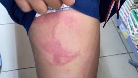 Imagem mostra marcas no corpo da criança