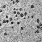 Pesquisa indica risco de monkeypox agravar infeccão por HIV