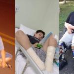 Infecção generalizada: criança sofre acidente de skate e precisa amputar as pernas