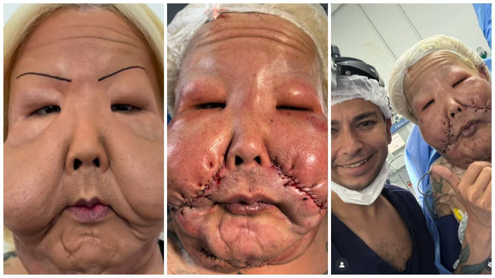 Médico mostra rosto de Juju do Pix seis meses após retirada de óleo mineral do rosto