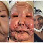 Influenciadora Juju do Pix passa por cirurgia para retirar óleo mineral do rosto