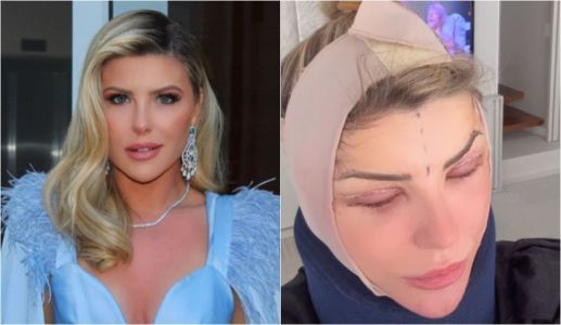 Iris Stefanelli passou por procedimento no rosto