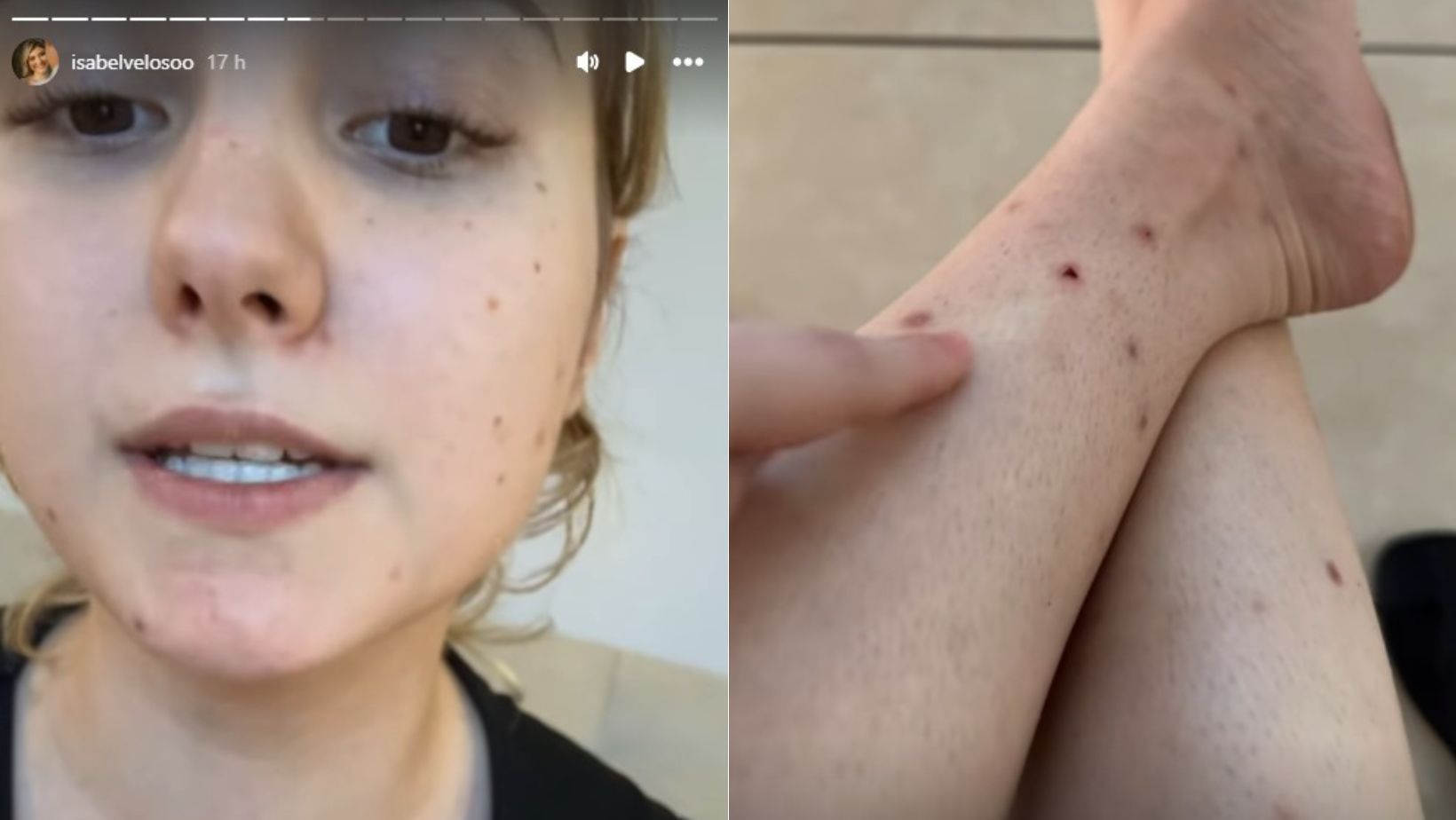 Isabel Veloso, influencer com câncer terminal, fala sobre picadas de pernilongo que não cicatrizam