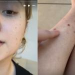 Isabel Veloso, influencer com câncer terminal, fala sobre picadas de pernilongo que não cicatrizam