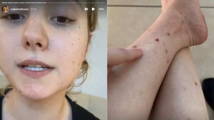 Isabel Veloso, influencer com câncer terminal, fala sobre picadas de pernilongo que não cicatrizam devido à doença