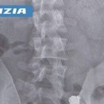 Homem engole fone de ouvido ao ser flagrado colando em prova