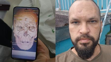 Homem teve fratura no crânio que se dividiu em mais de 30 fragmentos