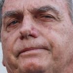 Bolsonaro apresenta piora da função renal, diz novo boletim médico