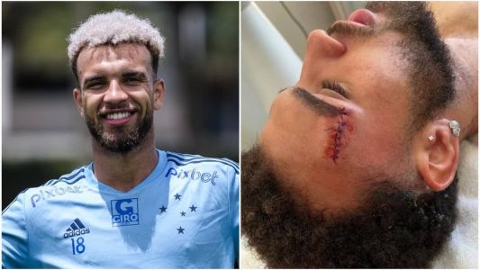 Jajá, ex-Cruzeiro, levou pontos na testa