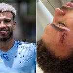 Ex-Cruzeiro, Jajá leva a pior em dividida e precisa tomar pontos na testa