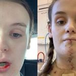 Estudante que teve câncer por morder a língua tem órgão reconstruído com músculos da perna; fotos