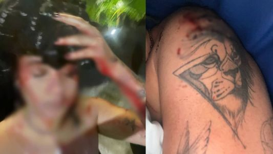 Jovem compartilhou fotos dos ferimentos nas redes sociais