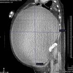 Mulher que acreditava ser obesa descobre cisto gigante no ovário