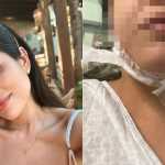 'Lipo de papada': defensoria pede bloqueio de bens de R$ 2,5 milhões de dentista em BH
