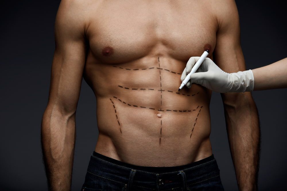 Luciana Pepino | Lipo HD masculina: a escultura corporal que vai além da estética