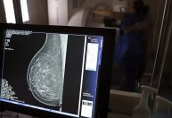 Taxa de mamografias na rede privada é mais que o dobro da registrada no SUS