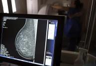 Planos de saúde terão de cobrir mamografia para qualquer idade e gênero