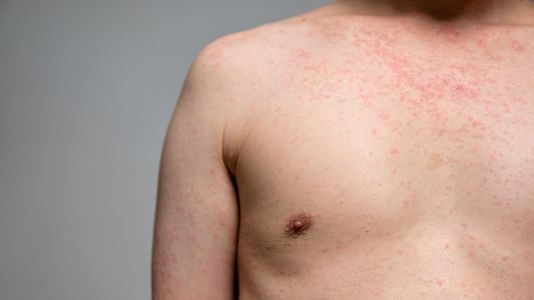 Homem com doses completas de vacina é o 1º caso de sarampo do ano em SP | CNN Brasil