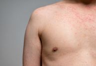 Ministério da Saúde alerta para risco de sarampo no Brasil durante Copa de 2026