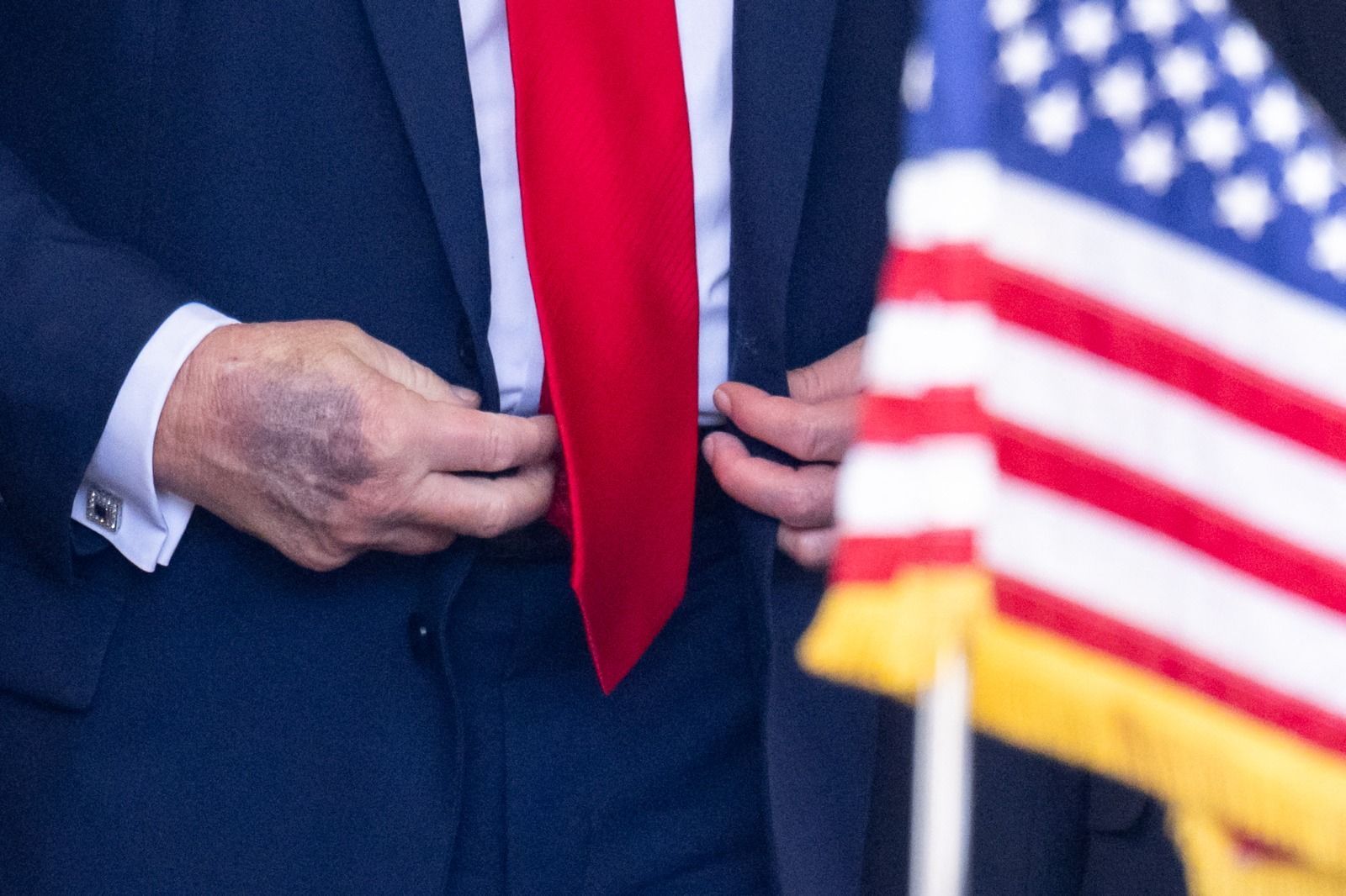 Trump volta a exibir hematomas roxos na mão durante evento na Casa Branca