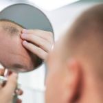 Anvisa aprova uso de remédio contra Covid-19 para tratamento de calvície