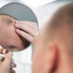 Anvisa alerta para crescimento anormal de pelos em bebês que tiveram contato com Minoxidil