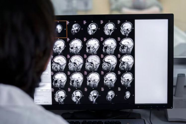 Anvisa aprova novo medicamento para tratar esclerose múltipla
