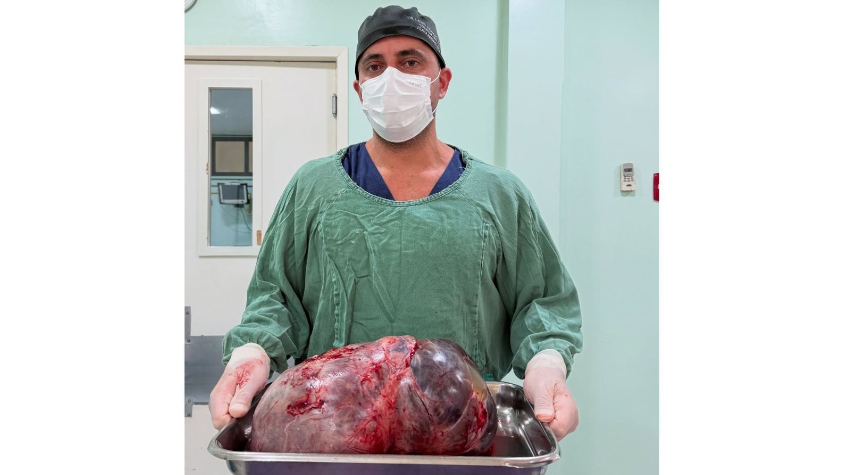 Médico retira tumor de 15 kg após diversas recusas médicas à paciente, no RJ; veja fotos