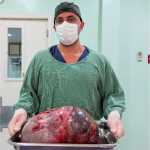Médico retira tumor de 15 kg após diversas recusas médicas à paciente, no RJ; veja fotos