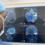 Mesmo casos leves de Covid-19 causam alterações no cérebro, aponta estudo