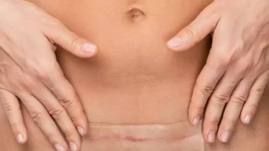 Para uma melhor recuperação da cirurgia plástica é fundamental entender o papel da microporagem e como ela deve ser feita