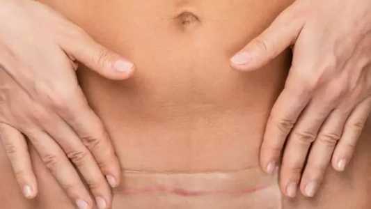 Para uma melhor recuperação da cirurgia plástica é fundamental entender o papel da microporagem e como ela deve ser feita