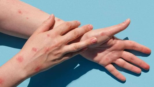 Minas tem 615 casos confirmados de varíola dos macacos