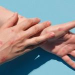 Minas registra 4ª morte por varíola dos macacos